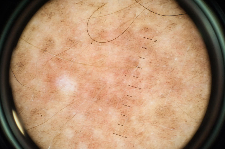 Dermoscopy of Sun Damaged Skin