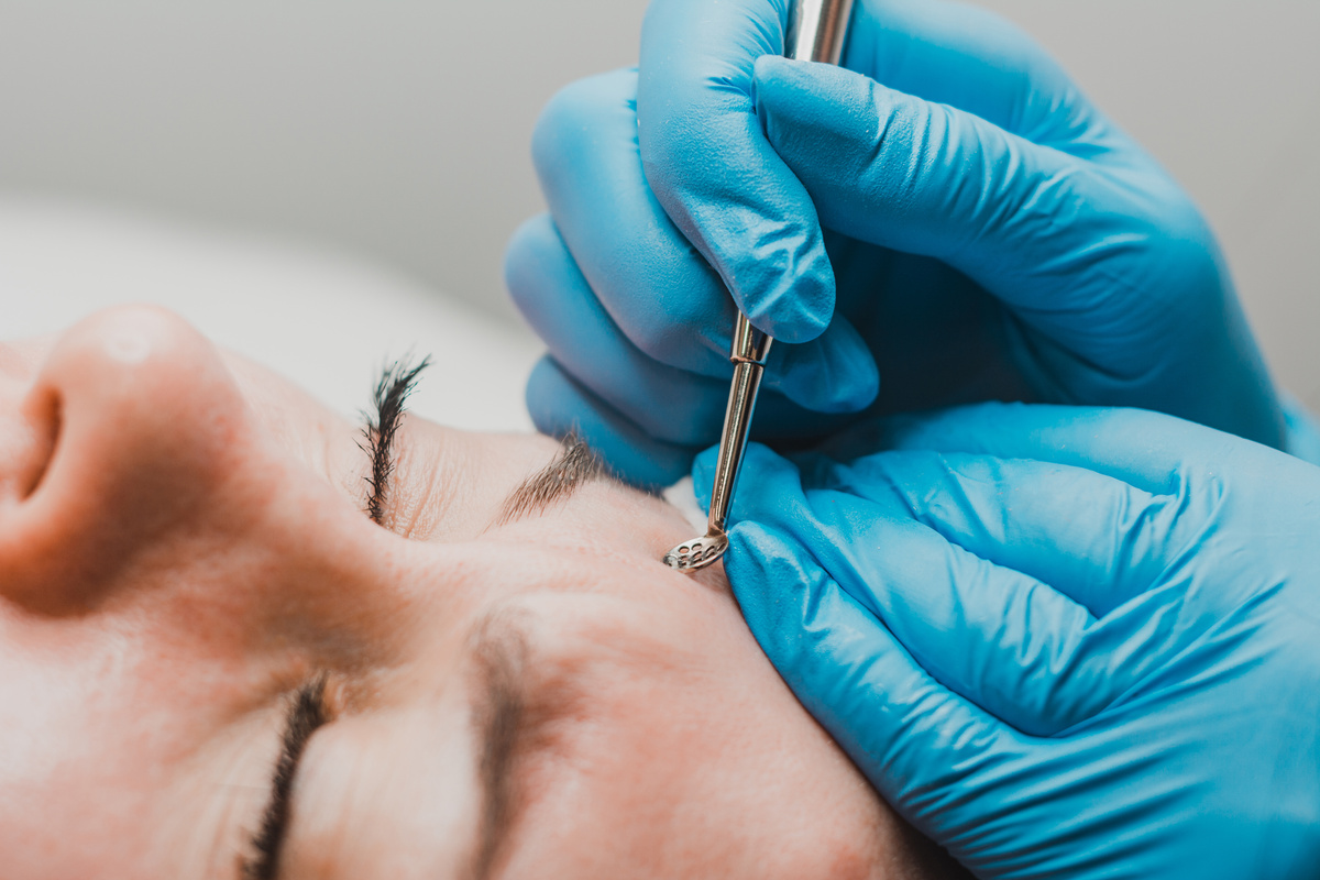 Mechanical facial cleansing, skin cleansing procedure from surface and deep impurities.