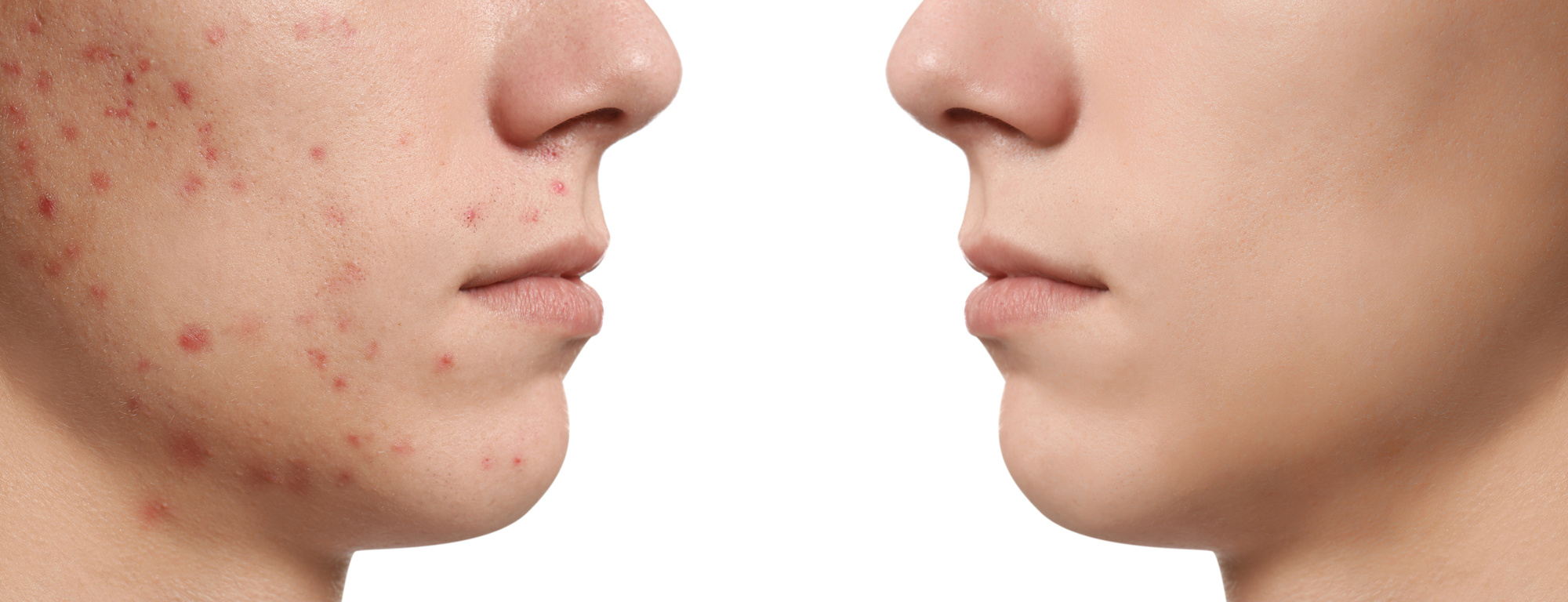 Teenager before and after Acne Treatment on White Background, Closeup